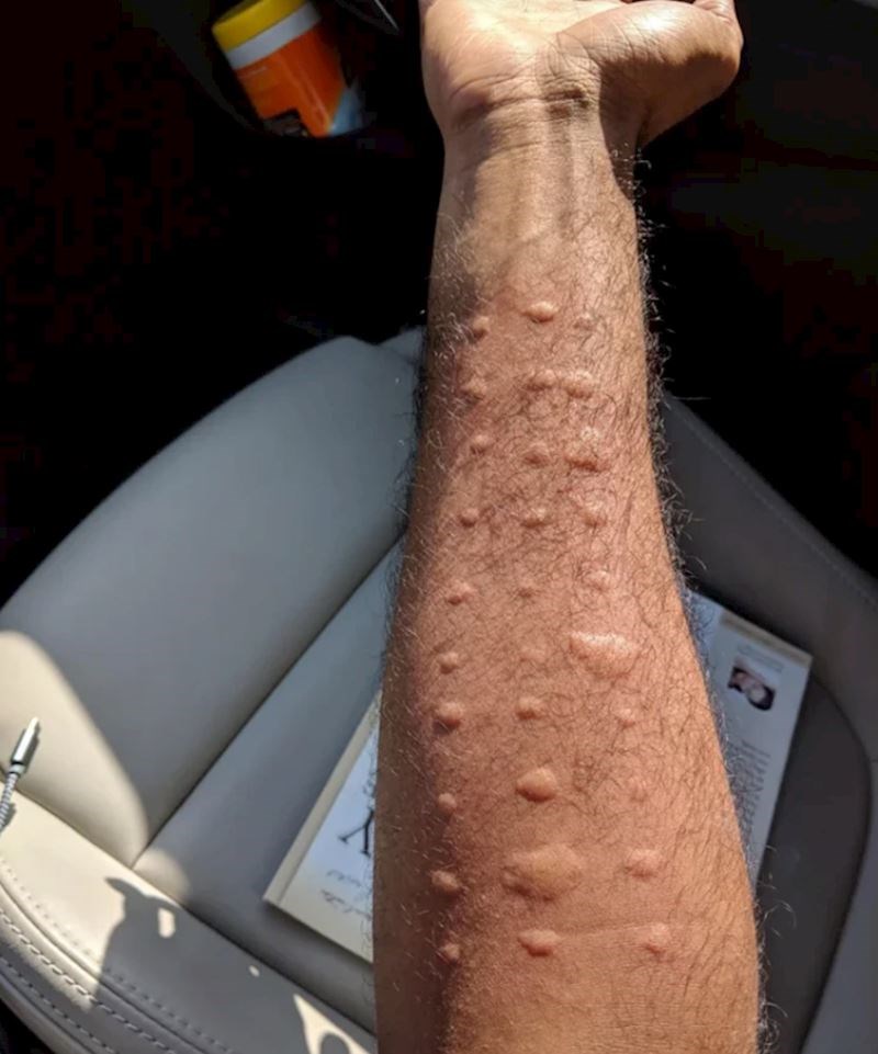 "Išao sam se testirati na alergije. Bolje da nisam..."