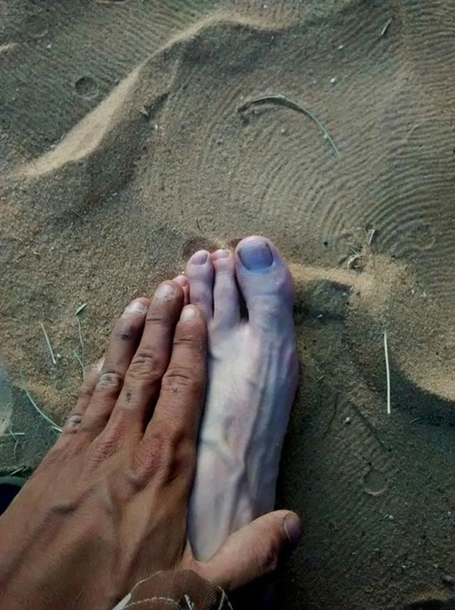 "Prirodna boja kože na stopalu u odnosu na ten na ruci koja je bila izložena suncu."