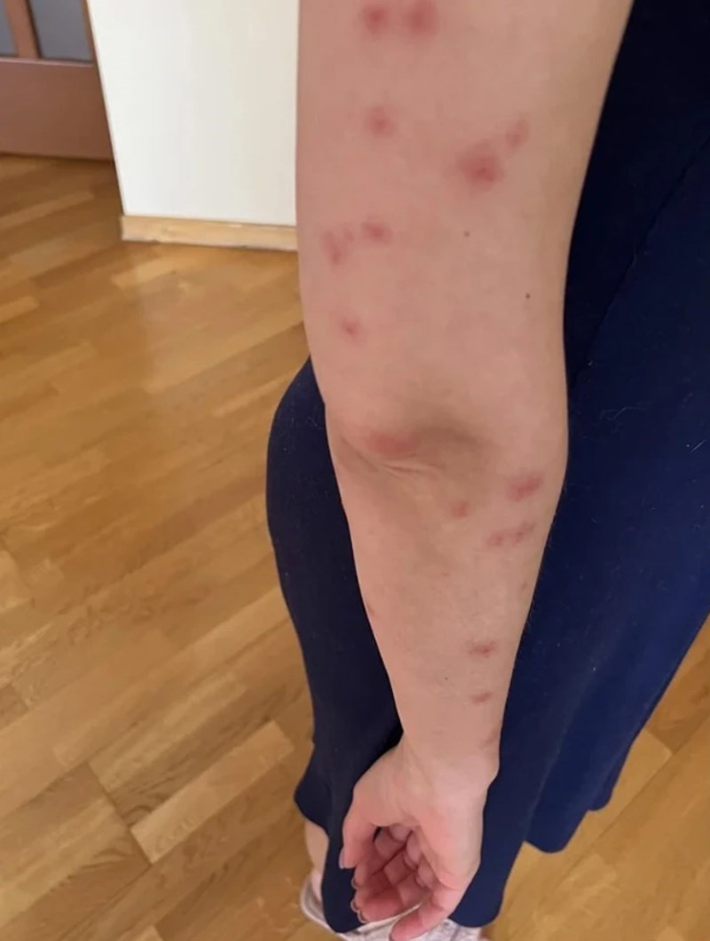 4. "Bili smo prespavali u hotelu i moju ženu su izgrizle neke bube. Sad je puna modrica."