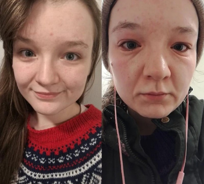 11. "Alergična sam na hladnoću."