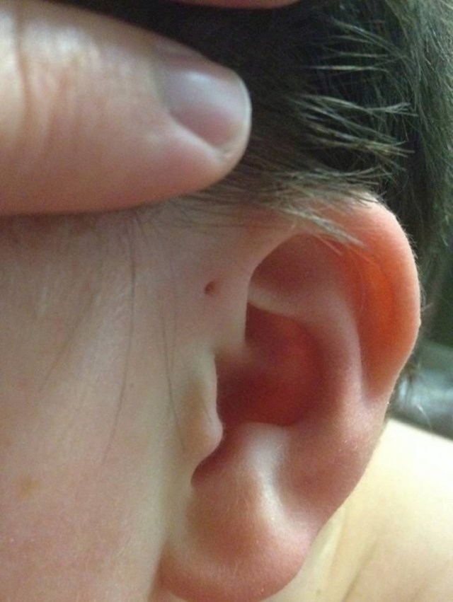 Imate li ovu rupicu kod uha? Neki znanstvenici tvrde da bi to mogli biti evolucijski ostaci škrga.