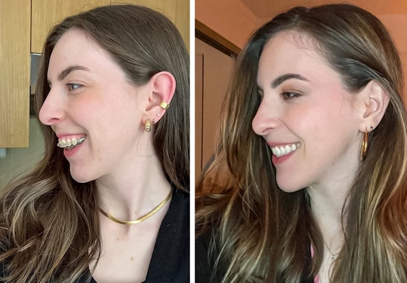 12. Osim što je presretna što je skinula aparatić za zube, oduševljena je kako joj sada izgleda čeljust