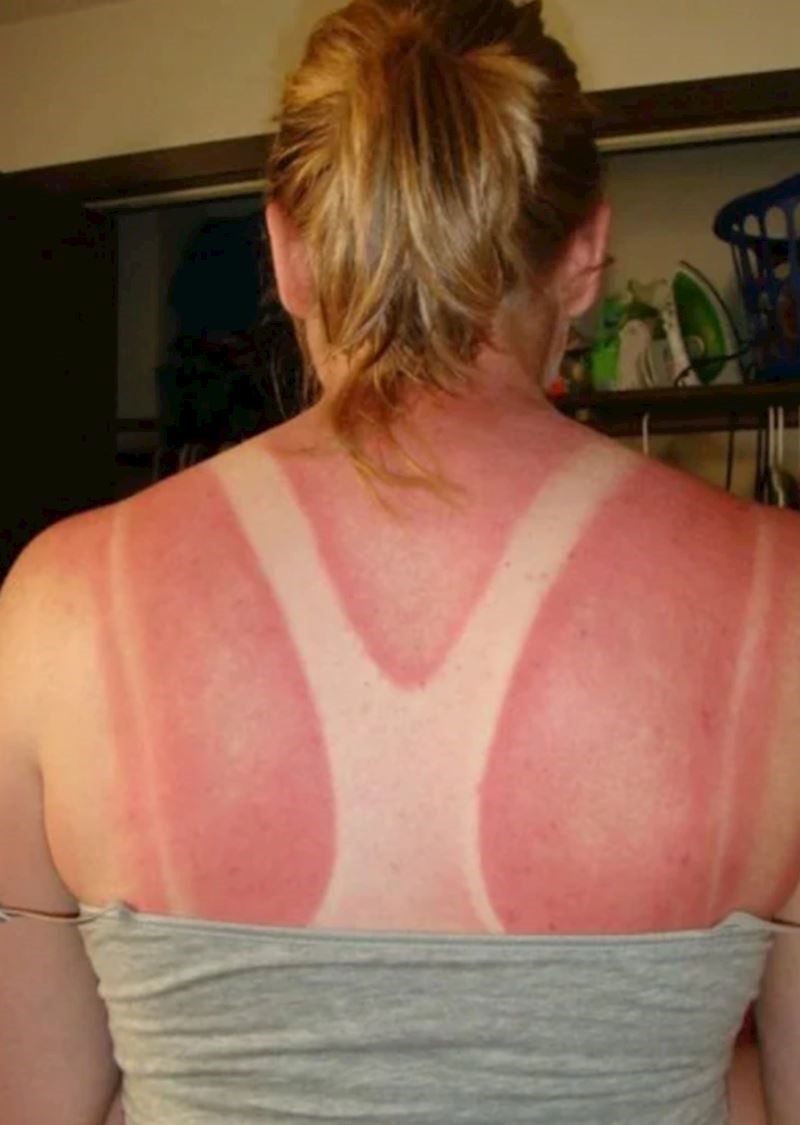 "Nosila sam top dok smo pješačili i nakon cijelog dana hodanja sam vidjela da sam ovako izgorila"