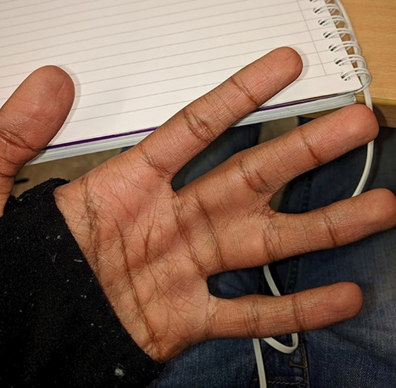 "Plivaća kožica" između dva prsta.