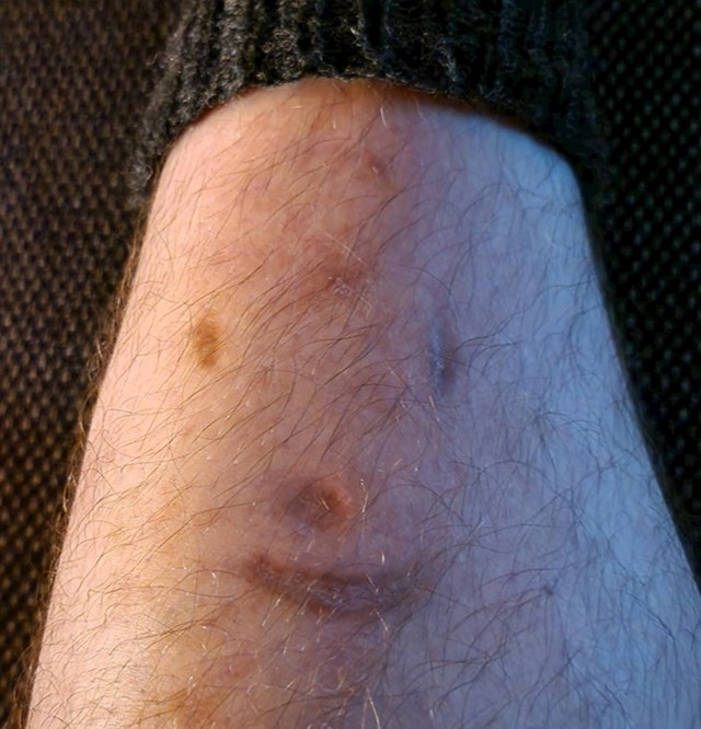 5. Ožiljak na mojoj nozi svaki dan mi se smješi