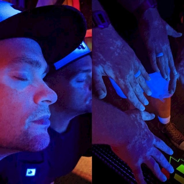 14. On je otkrio kako njegov vitiligo izgleda pod crnom svjetlošću