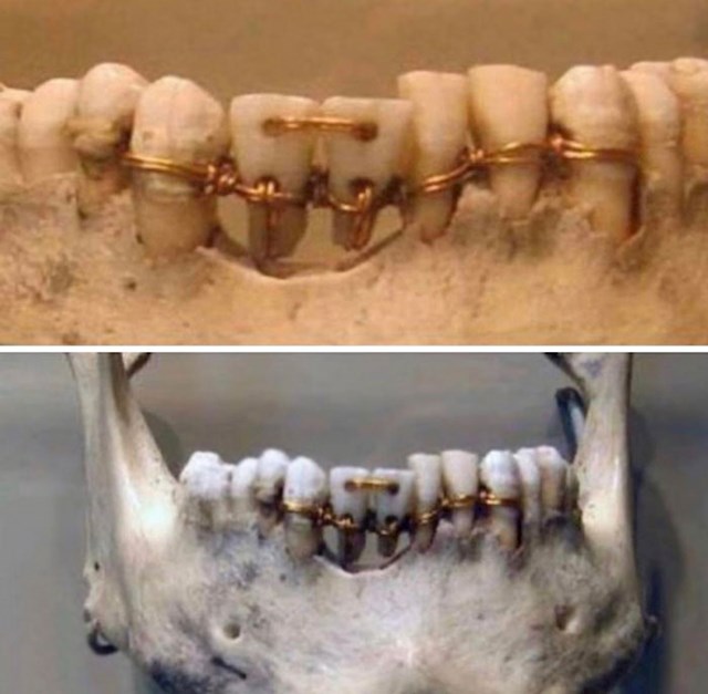 17. Ovako su stari Egipćani popravljali zube