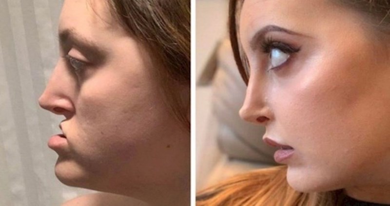 19 ljudi kojima je estetska kirurgija pomogla vratiti samopouzdanje