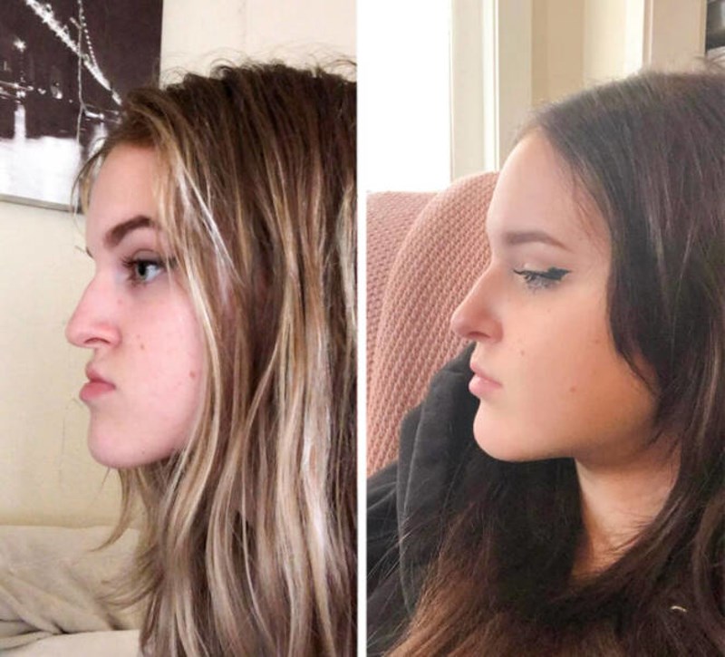 1. Podvrgnula sam se estetskoj operaciji i nisam požalila