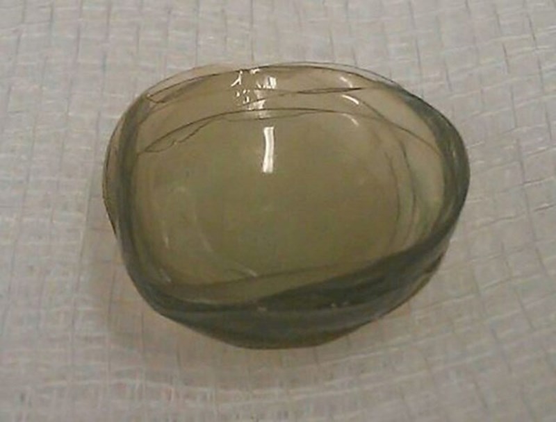 Nevjerojatno, ali sve ove leće je doktor našao u očima jedne pacijentice