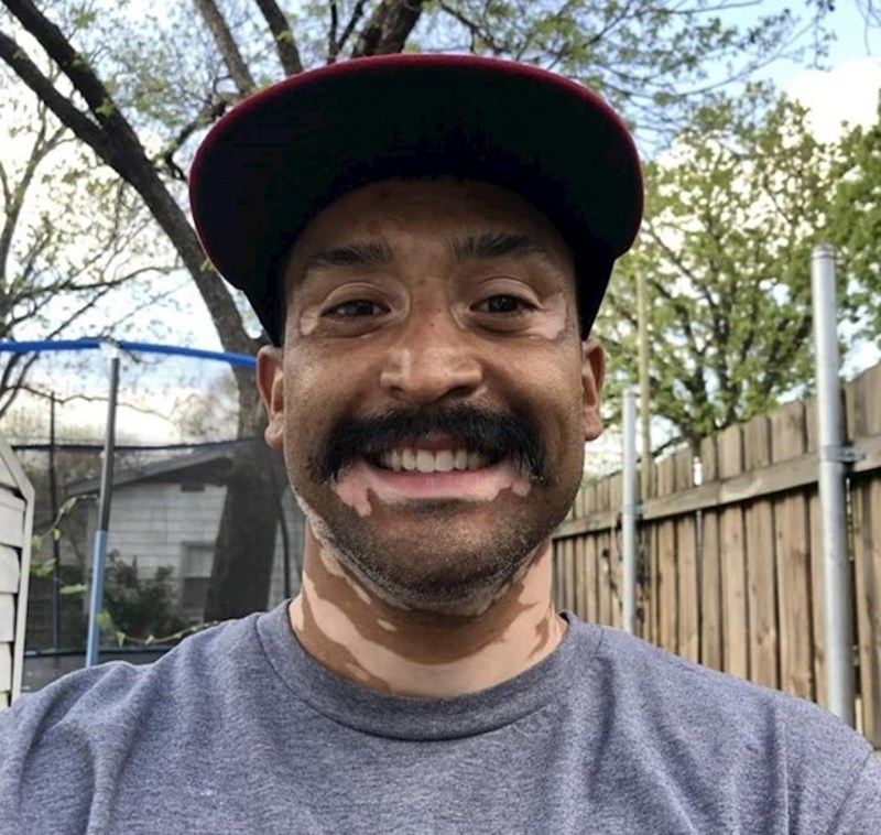 13. Ima genetsku bolest kože vitiligo, ali baš mu fora stoji.😄