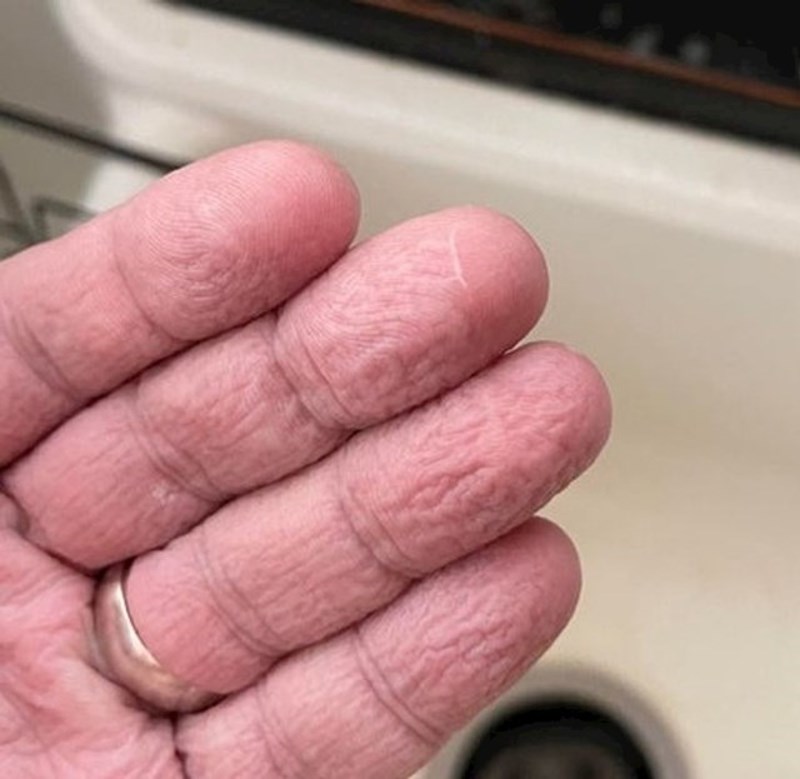 11. Dio prsta koji sam ozlijedio i koji su mi ponovno prišili nikad se ne smežura pod vodom.