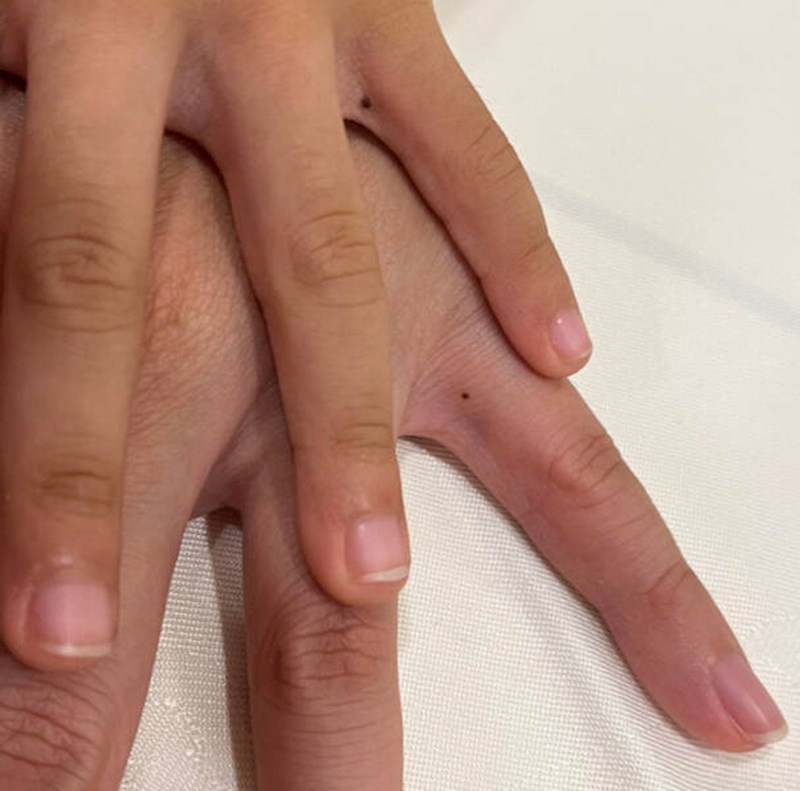 13. Tata i sin imaju madež na identičnom mjestu