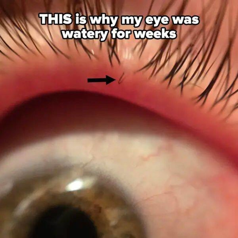 1. Zbog ove dječice koju nisam primijetila oko mi je tjednima suzilo