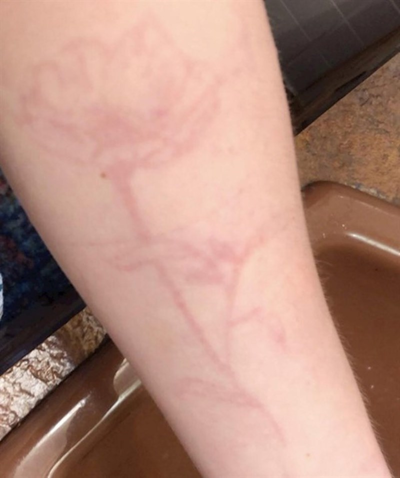 5. Izbila mi je alergija na ruci, a s njom se pojavio i ovaj cvijet