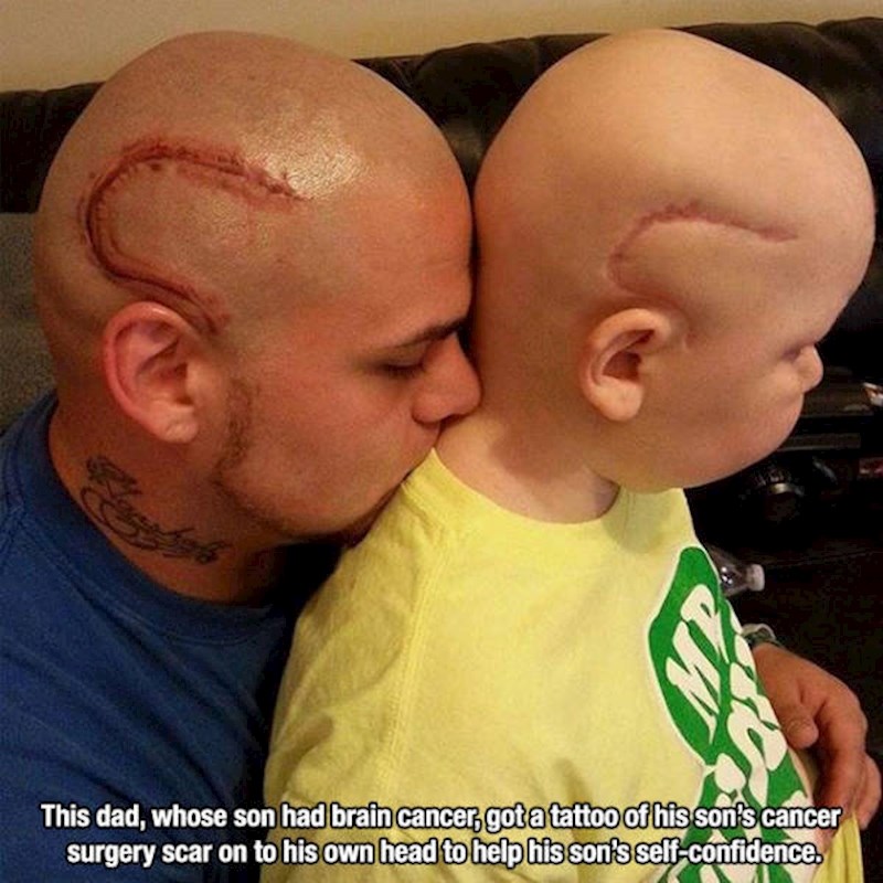 3. Sin mu ima zloćudni tumor na mozgu pa je napravio tetovažu identično njegovom ožiljku od operacije kako bi mu podigao samopouzdanje