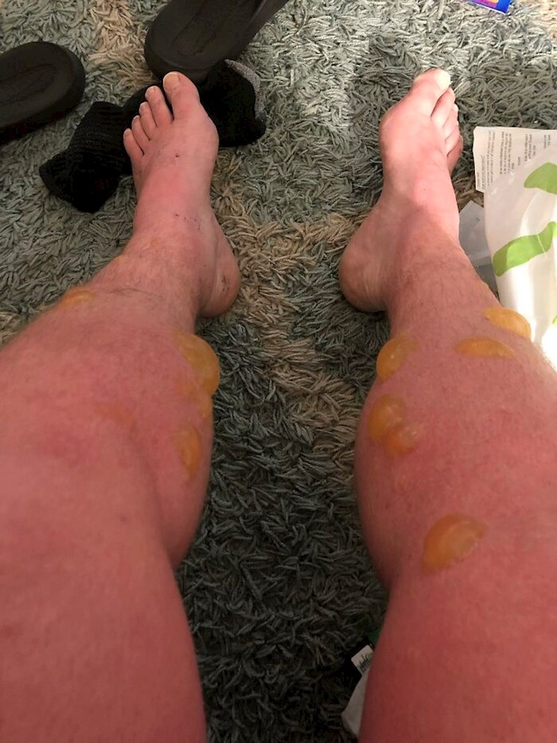 14. Ovo neka vam bude podsjetnik da UVIJEK stavite kremu za sunčanje kad dugo boravite na suncu. Ovaj je nesretnik, koji je inače blijede puti,  veslao rijekom cijeli dan i zaboravio se namazati.