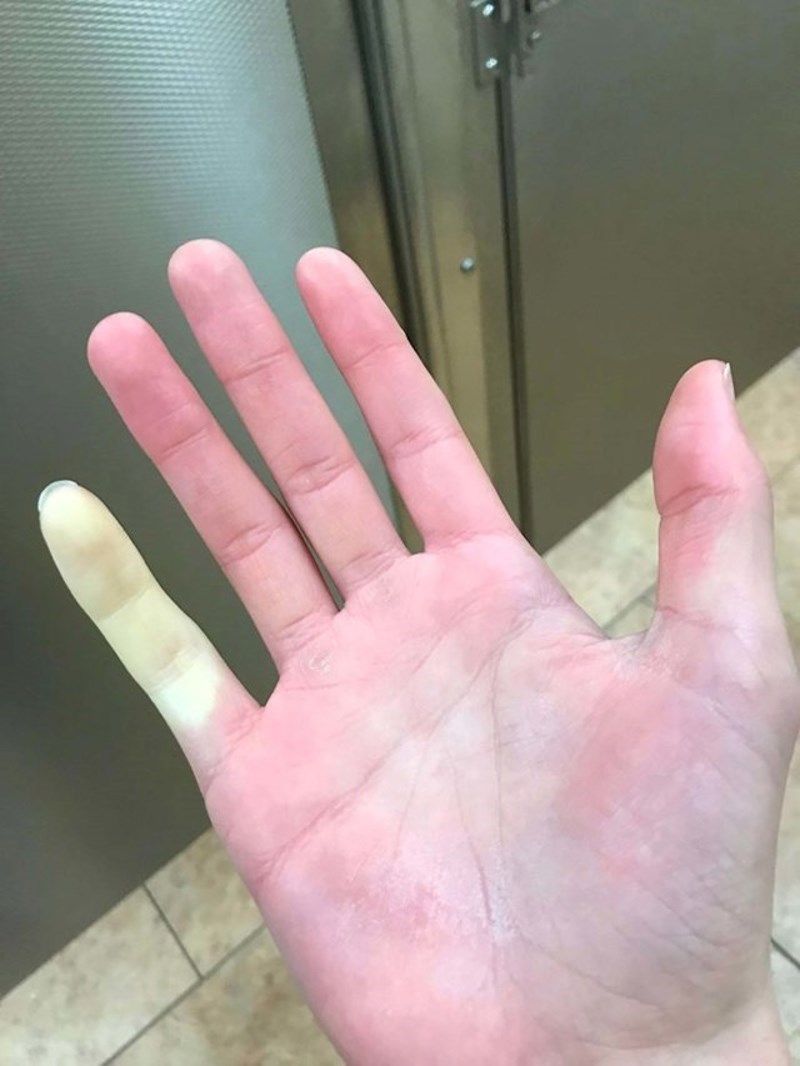 "Radila sam vani po zimi i samo ovaj mali prst mi je ozebao."