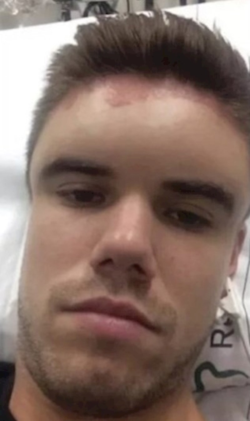 4. Na teži način saznao je da je alergičan na boju za kosu.