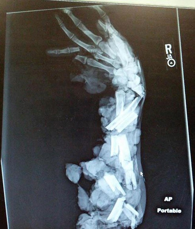 5. Ovako izgleda rendgenska snimka nečije ruke koju je zdrobila mašina za mljevenje mesa. Auč!