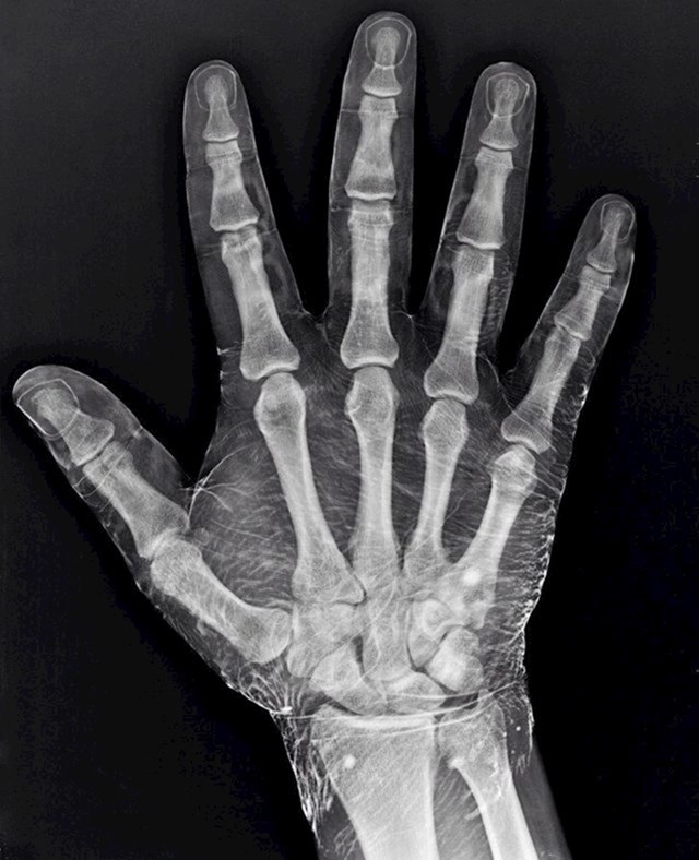 2. Rendgenska slika ruke umočene u jod. Jod utječe na sliku tako što prikazuje i mesnato tkivo oko kostiju.