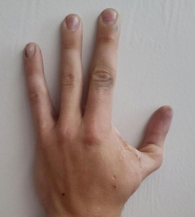 18. Moj muž rođen je bez palca pa su mu na njegovo mjesto prišili kažiprst