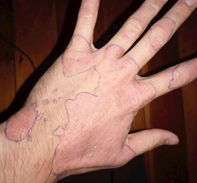 12. Iscrtao je ožiljke na svojoj ruci i pretvorio ih u mapu