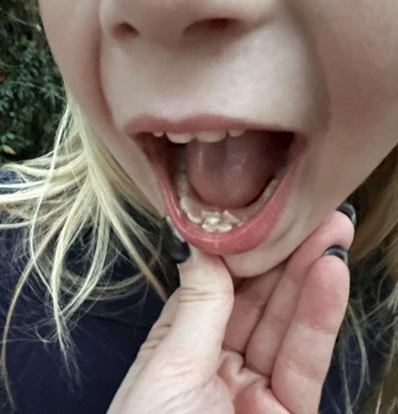 11. Mojoj kćeri počeli su rasti trajni zubi, a mliječni još nisu ispali