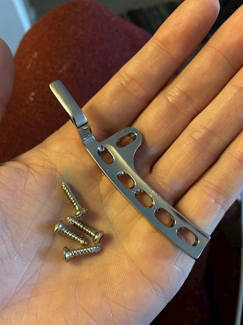 Kirurg mi je nakon operacije dao vijke i metalnu šipku koju imam u nozi