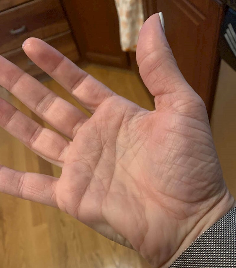 15. Uhvatio ju je grč na lijevoj strani ruke i doslovno ga možete vidjeti