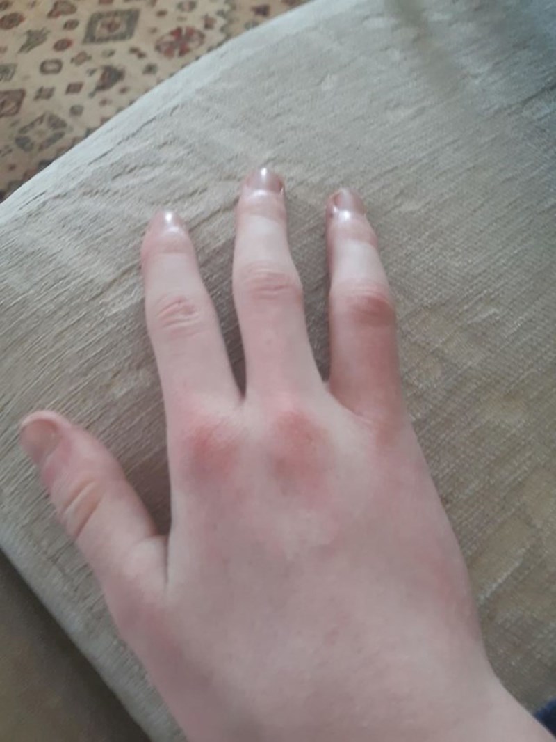 "Rođena sam s četiri prsta."