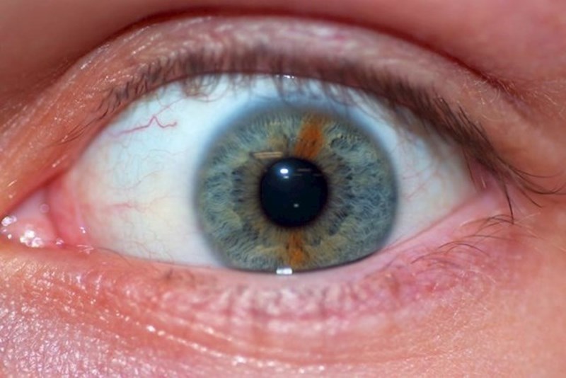 "Moje oko ima smeđu prugu usred plavo zelene šarenice."