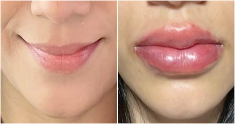 15 ljudi koji su se podvrgnuli estetskim zahvatima i izvukli deblji kraj, rezultati su grozni