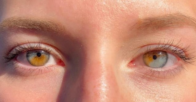 1. Žena ima heterokromiju na oba oka