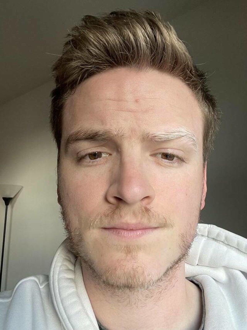 1. Samo jedna od mojih obrva gubi pigment