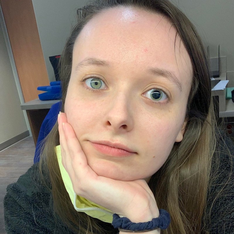 8. Imam anizokoriju, stanje koje uzrokuje nejednaku veličinu trepavica