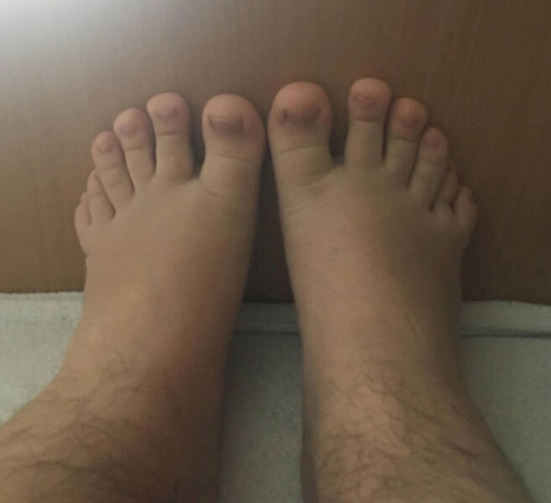 14. Ima šest prstiju na svakom stopalu