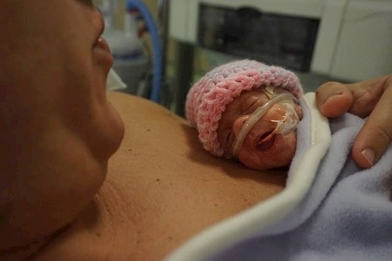 2. Naša prerano rođena curica izgleda kao malena kornjača