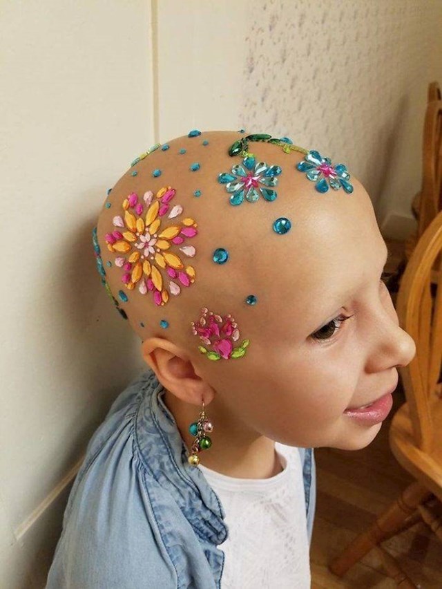 17. Dijagnosticirali su joj alopeciju, ali to ne znači da ne može imati zanimljive "frizure"😉