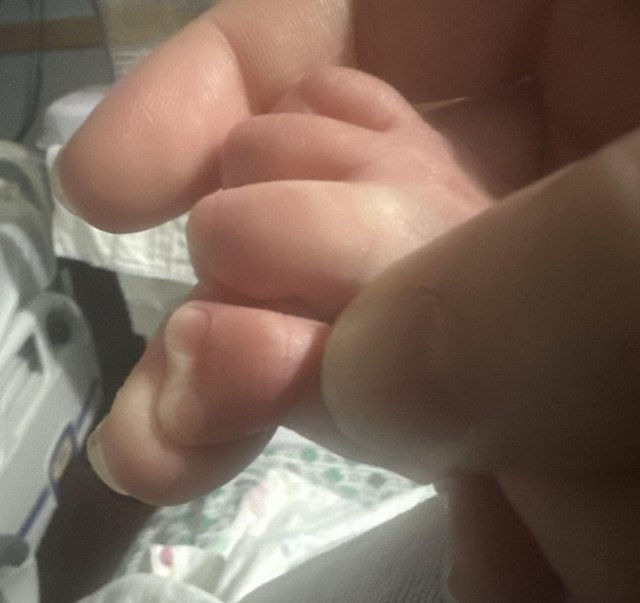 Sin se rodio s palcem u obliku srca