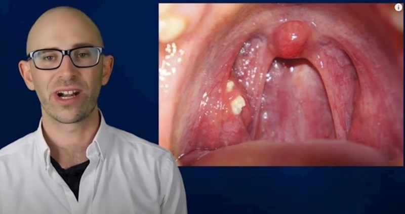 Jeste li ikad primijetili ove bijele točke u ustima? Genijalan video otkriva o čemu se radi