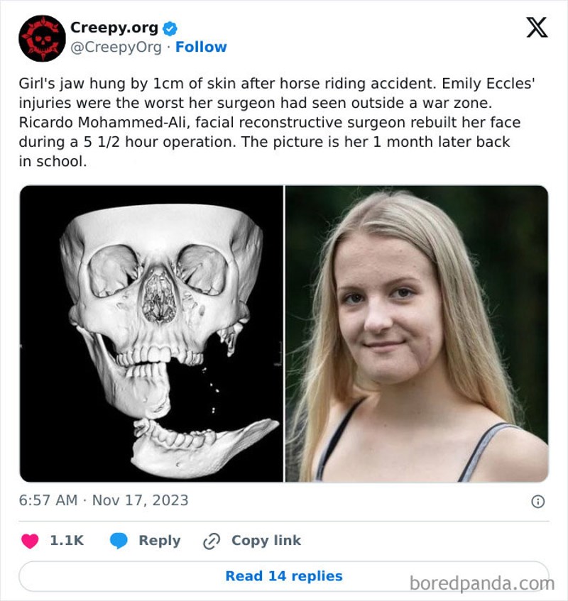 Emily je slomila lubanju nakon pada s konja. Desno je fotka nakon operacije