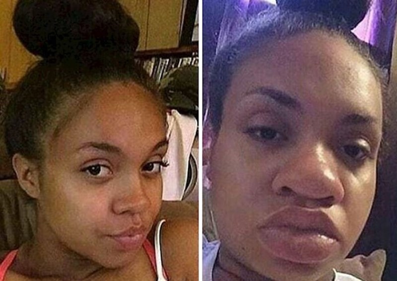 Neki dijelovi tijela naglo će se početi povećavati, jako često u pitanju je nos