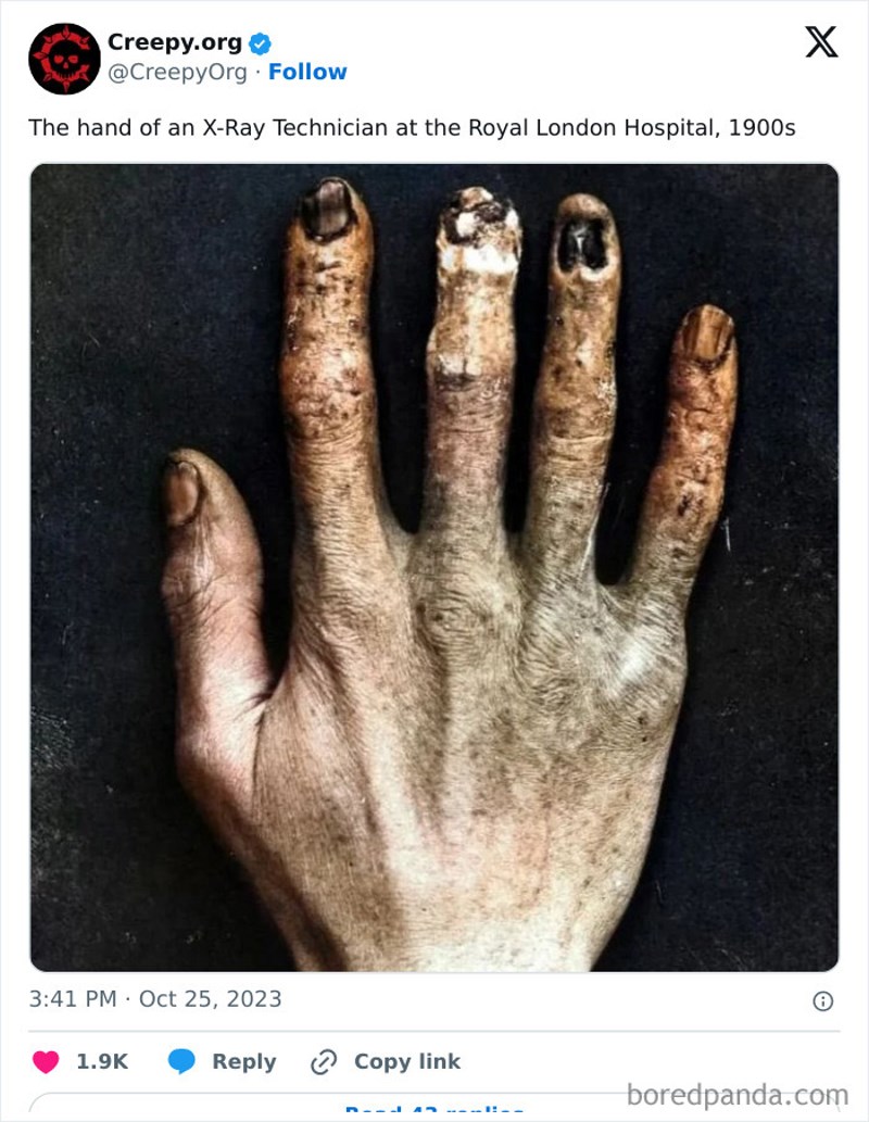 Ovo je ruka tehničara koji je radio rendgenske snimke prije nego se znalo da zrače