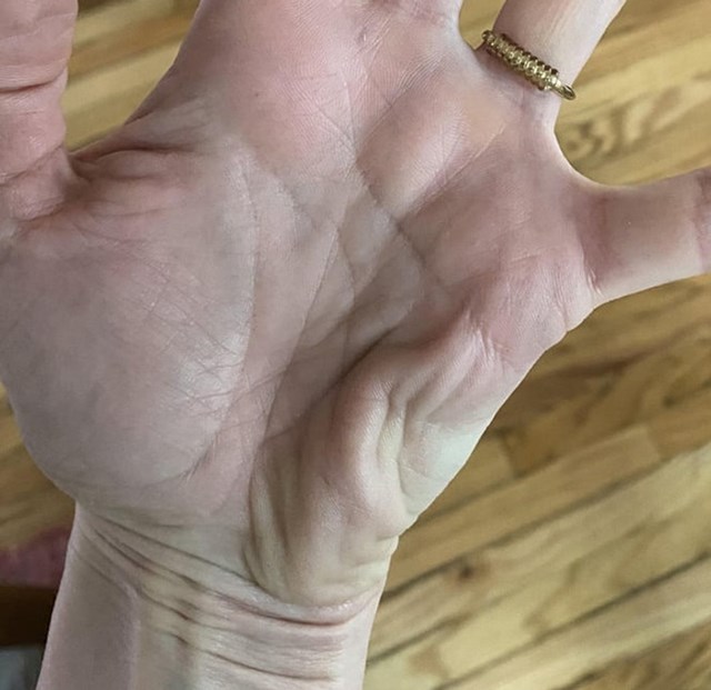 Mišići dlana