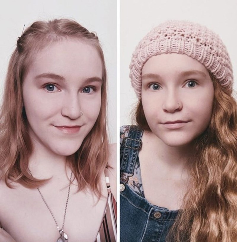 3. "Prošlo je mjesec dana otkako sam operirala čeljust. Boli i nije lako, ali se isplati"