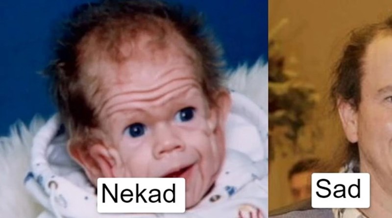 Nevjerojatna priča o dječaku koji je 20 godina zbunjivao doktore, pogledajte kako izgleda danas