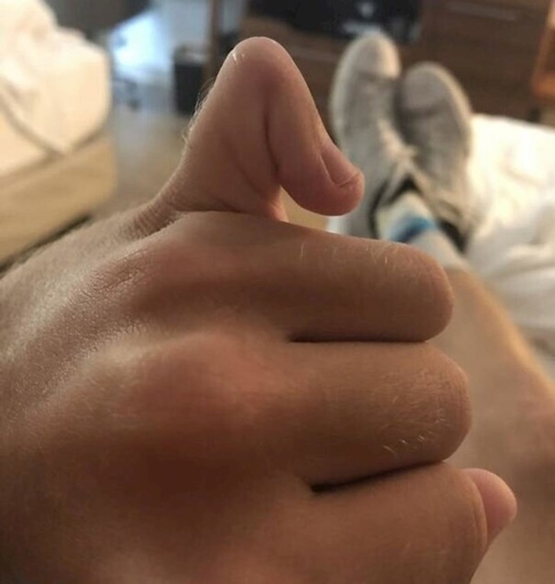 Ima samo jedan zglob na malom prstu