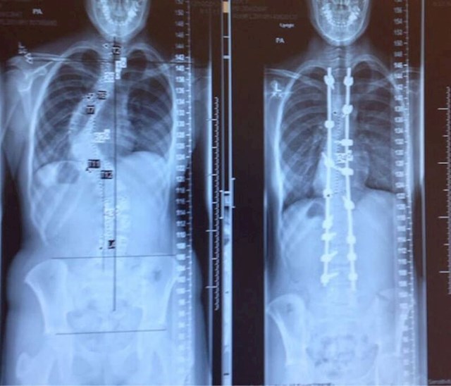 Rendgenska snimka prije i nakon operacije ispravljanja skolioze