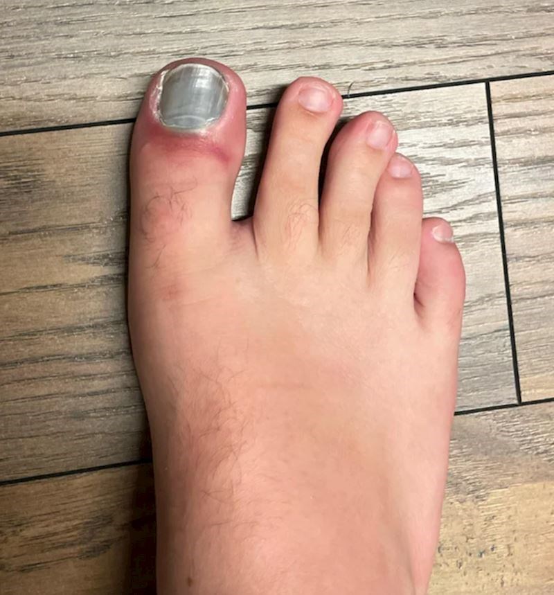 Pao mi je stol na stopalo